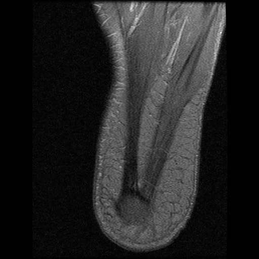 File:Anterior calcaneal process fracture (Radiopaedia 74654-85611 Axial PD fat sat 29).jpg