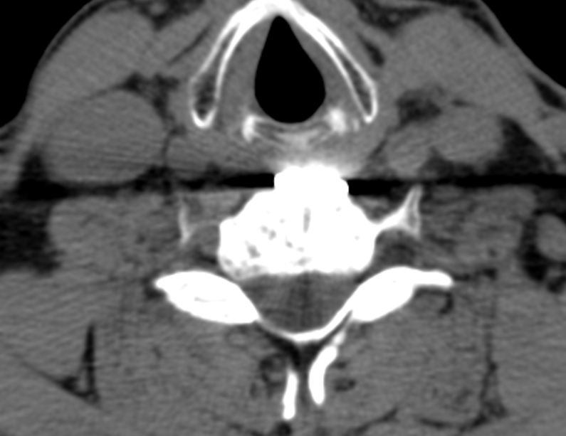 Anterior cervical postdiscectomy arthrodesis (Radiopaedia 32678-33646 Axial non-contrast 53).jpg