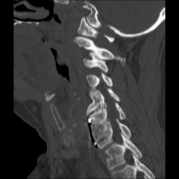 Anterior cervical postdiscectomy arthrodesis (Radiopaedia 32678-33646 Sagittal bone window 49).jpg