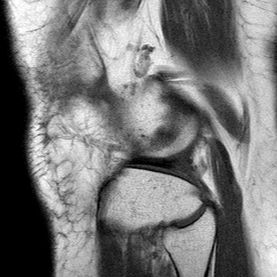 Anterior cruciate ligament mucoid degeneration (Radiopaedia 60853-68633 Sagittal T1 52).jpg
