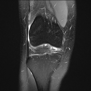 File:Anterior cruciate ligament rupture and posteromedial corner injury (Radiopaedia 67338-76723 Coronal PD fat sat 19).jpg