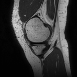 Anterior cruciate ligament rupture and posteromedial corner injury (Radiopaedia 67338-76723 Sagittal PD 39).jpg