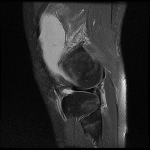 File:Anterior cruciate ligament tear (Radiopaedia 61500-69462 Sagittal PD fat sat 17).jpg