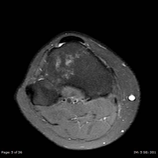 File:Anterior cruciate ligament tear (Radiopaedia 70783-80964 Axial PD fat sat 5).jpg