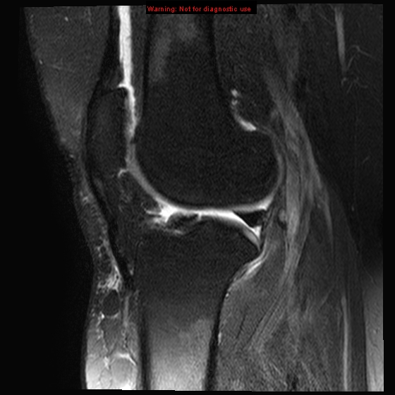 File:Anterior cruciate ligament tear - complete (Radiopaedia 12175-12514 Sagittal T2 fat sat 9).jpg