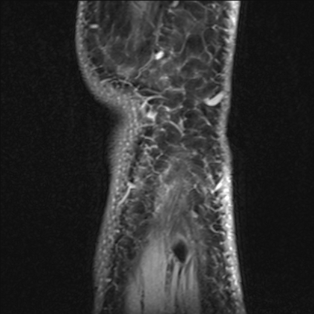 Anterior cruciate ligament tear - ramp lesion (Radiopaedia 71883-82322 Sagittal T1 vibe 9).jpg