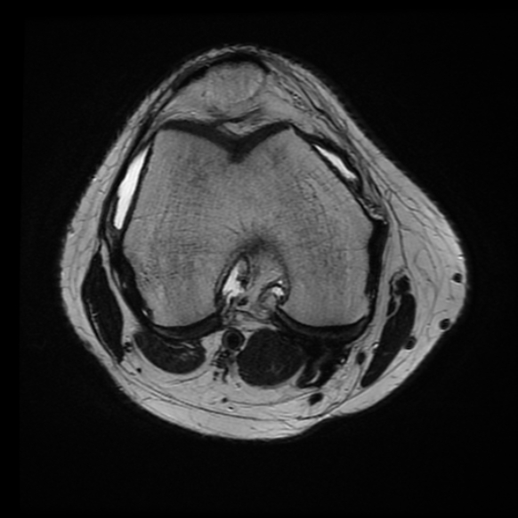 File:Anterior cruciate ligament tear with posteromedial corner injury, bucket-handle meniscal tear and chondral delamination (Radiopaedia 75501-86744 Axial T2 15).jpg