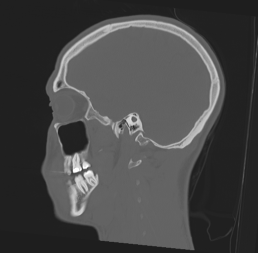File:Anterior nasal spine fracture (Radiopaedia 46138-50494 Sagittal bone window 19).png