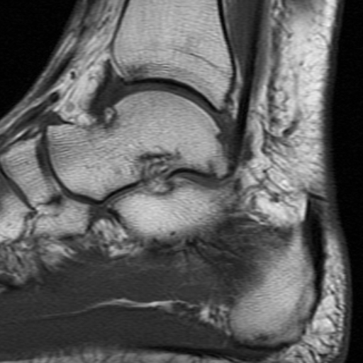 File:Anterior talofibular ligament rupture (Radiopaedia 15831-15484 Sagittal T1 12).jpg