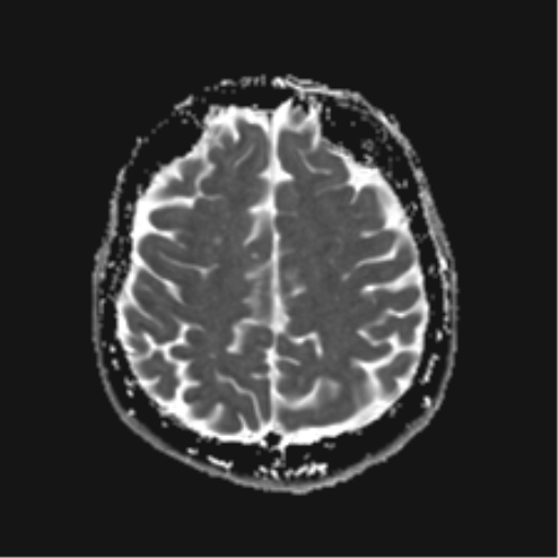 File:Anterior temporal lobe perivascular space (Radiopaedia 40946-43650 Axial ADC 21).png
