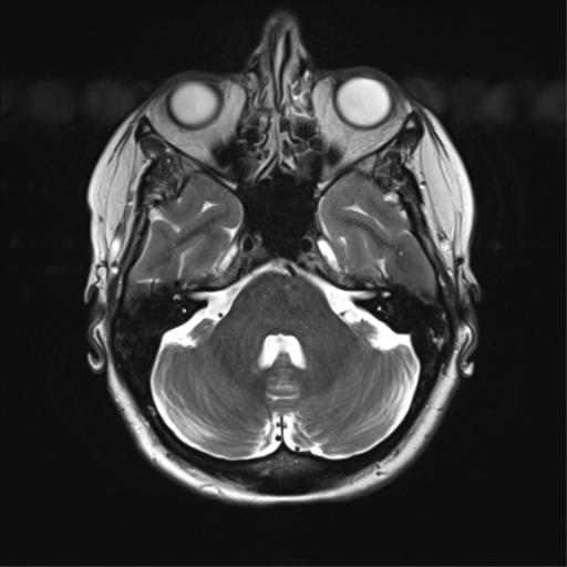 File:Anterior temporal lobe perivascular space (Radiopaedia 40946-43650 Axial T2 10).png