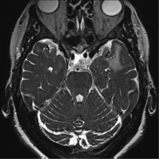 Anterior temporal pole cysts (Radiopaedia 46629-51102 Axial 34).png