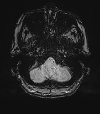 Anterior temporal pole cysts (Radiopaedia 46629-51102 Axial SWI 14).png