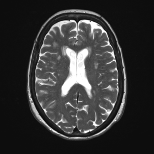 File:Anterior temporal pole cysts (Radiopaedia 46629-51102 C 23).png