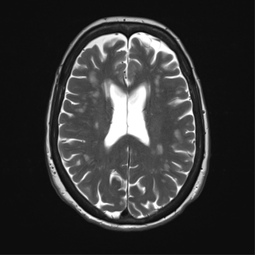 File:Anterior temporal pole cysts (Radiopaedia 46629-51102 C 24).png