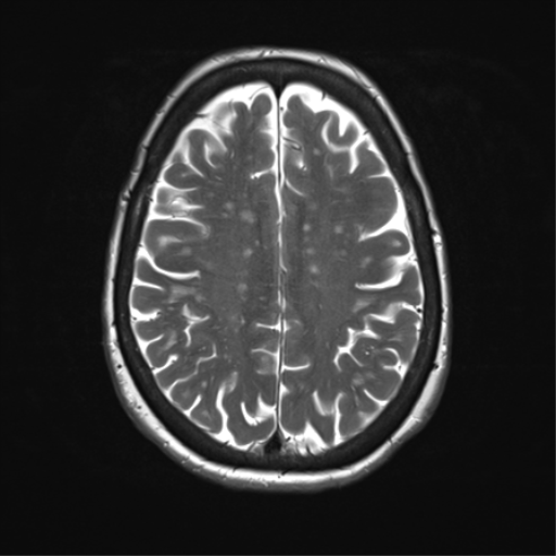 File:Anterior temporal pole cysts (Radiopaedia 46629-51102 C 27).png