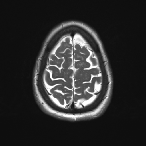File:Anterior temporal pole cysts (Radiopaedia 46629-51102 C 32).png