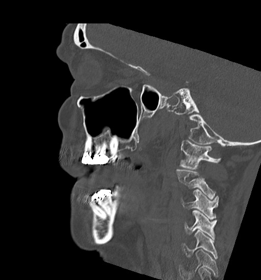 File:Anterior temporomandibular joint dislocation (Radiopaedia 59430-66784 B 42).jpg