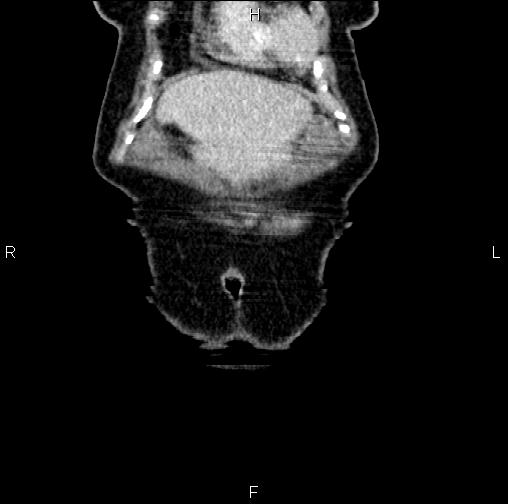 Aortic aneurysm and Lemmel syndrome (Radiopaedia 86499-102554 C 2).jpg