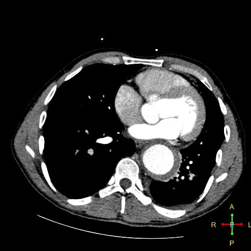 File:Aortic aneurysm and penetrating ulcer (Radiopaedia 23590-23704 A 21).jpg