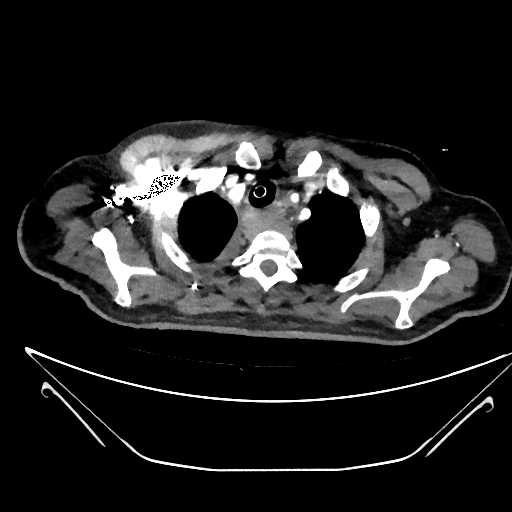 Aortic arch aneurysm (Radiopaedia 84109-99365 C 1).jpg