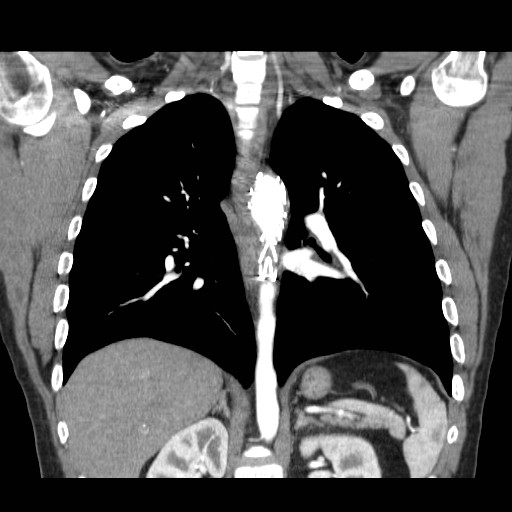 File:Aortic arch stent (Radiopaedia 30030-30595 F 20).jpg