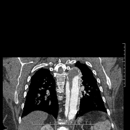 Aortic dissection- Stanford A (Radiopaedia 35729-37268 E 4).jpg