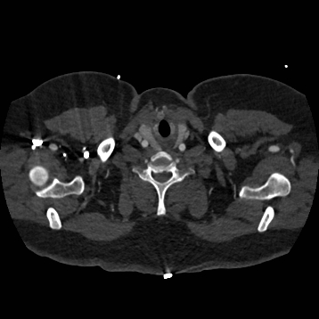 Aortic dissection (Radiopaedia 57969-64959 A 6).jpg