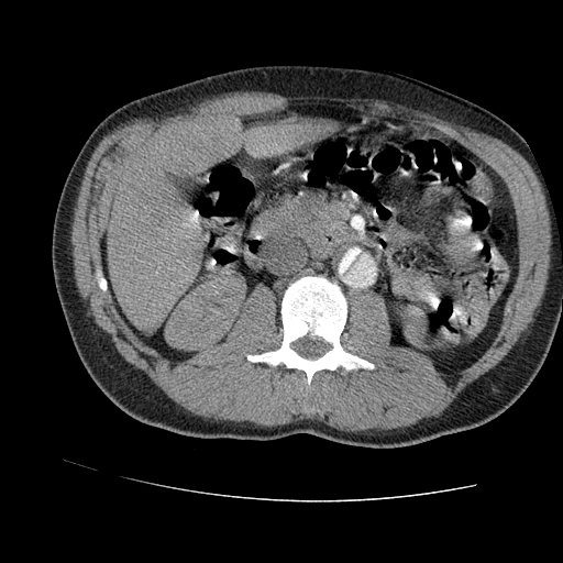 File:Aortic dissection - Stanford A -DeBakey I (Radiopaedia 28339-28587 B 132).jpg