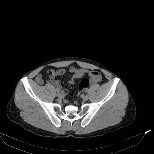 Aortic dissection - Stanford type A (Radiopaedia 83418-98500 Axial non-contrast 77).jpg
