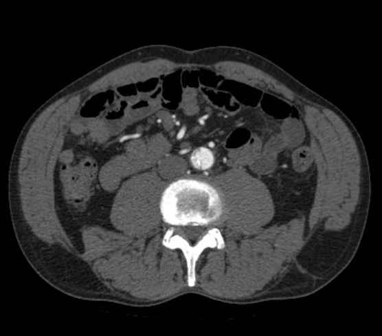 Aortic dissection - Stanford type B (Radiopaedia 73648-84437 A 179).jpg