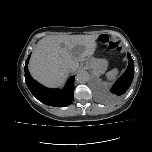 File:Aortic dissection extended to lusory artery (Radiopaedia 43686-47136 Axial non-contrast 26).jpg