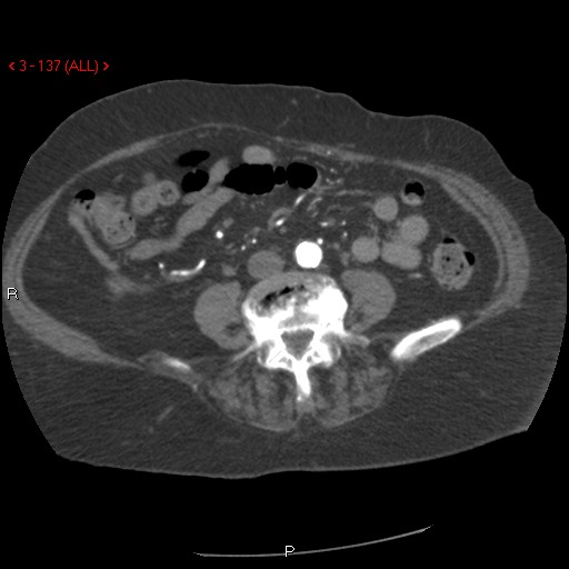 Aortic intramural hematoma (Radiopaedia 27746-28001 A 137).jpg