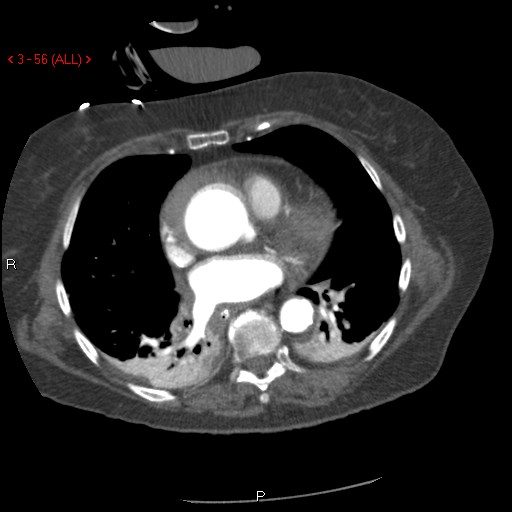 Aortic intramural hematoma (Radiopaedia 27746-28001 A 56).jpg