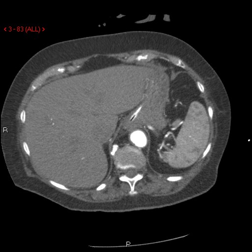 Aortic intramural hematoma (Radiopaedia 27746-28001 A 83).jpg
