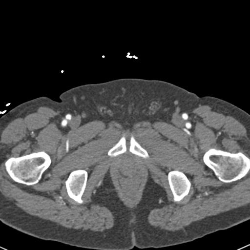 Aortic intramural hematoma (Radiopaedia 31139-31838 B 175).jpg