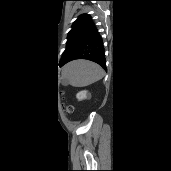 Aortic intramural hematoma (type B) (Radiopaedia 79323-92387 H 2).jpg