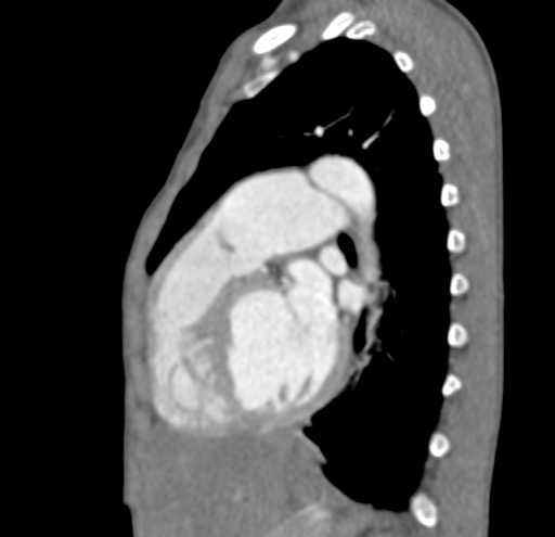 File:Aortopulmonary window, interrupted aortic arch and large PDA giving the descending aorta (Radiopaedia 35573-37074 C 29).jpg