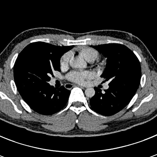 Apical lung mass mimic - neurogenic tumor (Radiopaedia 59918-67521 A 41).jpg