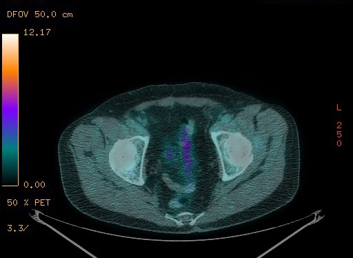 Appendiceal adenocarcinoma complicated by retroperitoneal abscess (Radiopaedia 58007-65041 Axial PET-CT 180).jpg