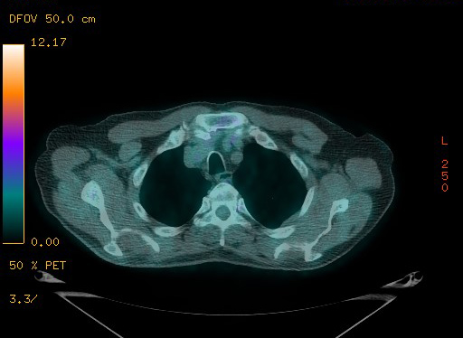 File:Appendiceal adenocarcinoma complicated by retroperitoneal abscess (Radiopaedia 58007-65041 Axial PET-CT 42).jpg