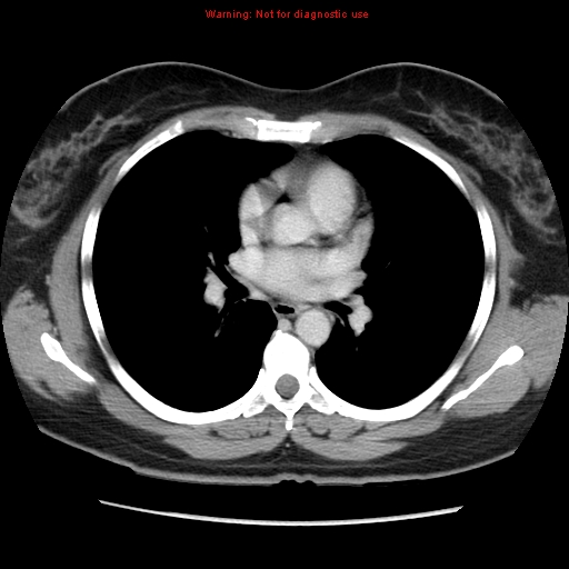 File:Appendiceal mucinous cystadenoma (Radiopaedia 8263-9111 Axial liver window 2).jpg