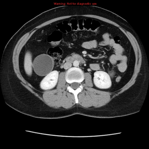 File:Appendiceal mucinous cystadenoma (Radiopaedia 8263-9111 Axial liver window 39).jpg