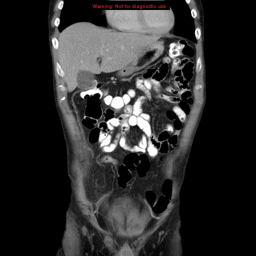 File:Appendicitis and renal cell carcinoma (Radiopaedia 17063-16760 B 8).jpg
