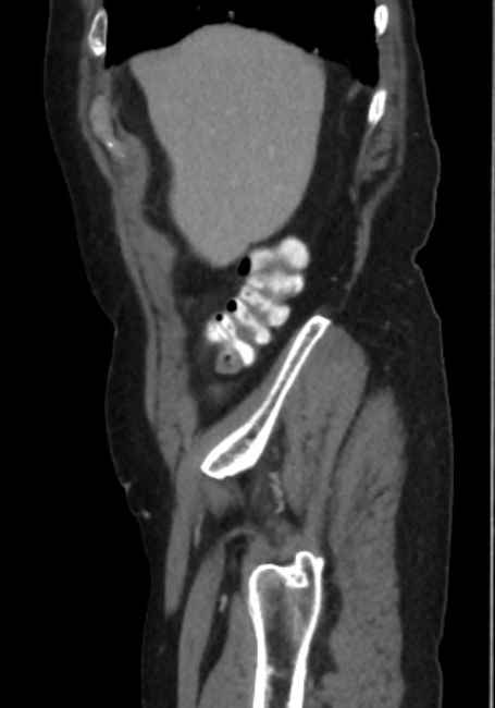 Appendicitis due to chicken fibula (Radiopaedia 74314-85198 C 14).jpg