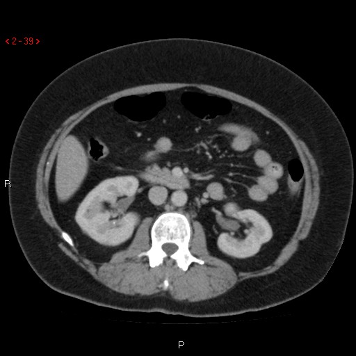 Appendicitis with microperforation- promontoric type (Radiopaedia 27268-27442 C 27).jpg
