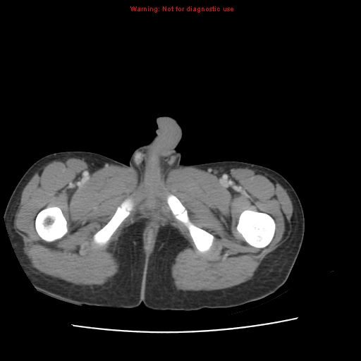 Appendicitis with phlegmon (Radiopaedia 9358-10046 A 76).jpg