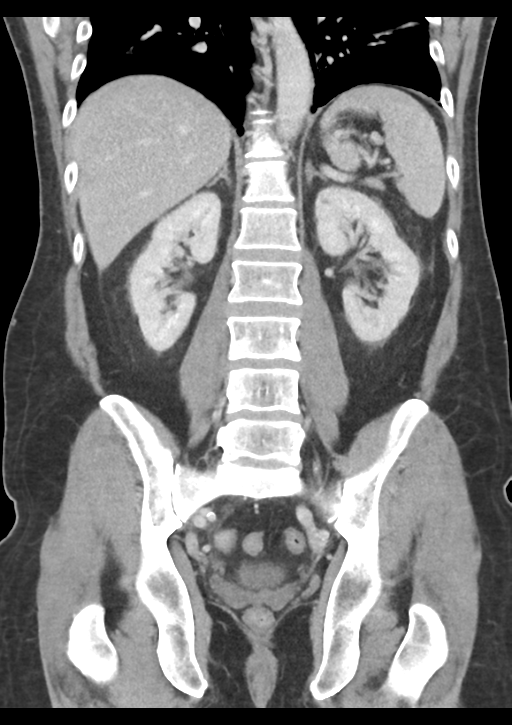 Appendicitis with thickening of the terminal ileum (Radiopaedia 42432-45550 B 39).png