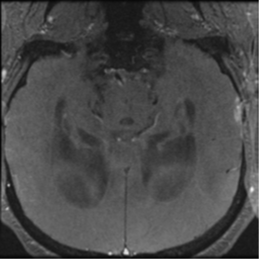 Aqueduct stenosis with corpus callosum hypoattenuation post shunting (Radiopaedia 37212-38969 Axial CSF Flow 35).png