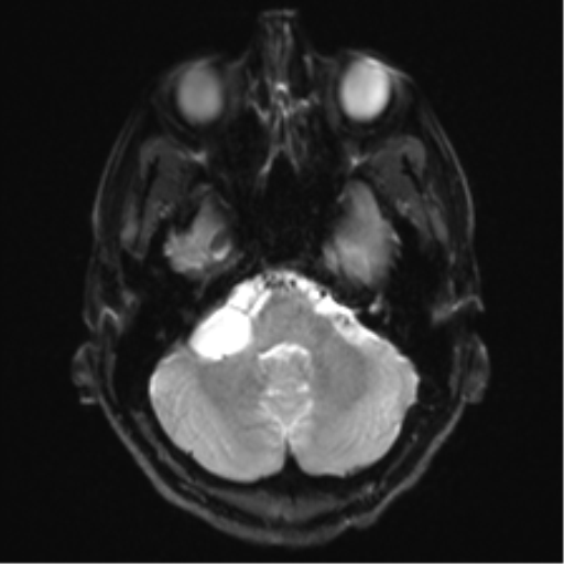 Arachnoid cyst - cerebellopontine angle (Radiopaedia 59689-67083 Axial DWI 8).png
